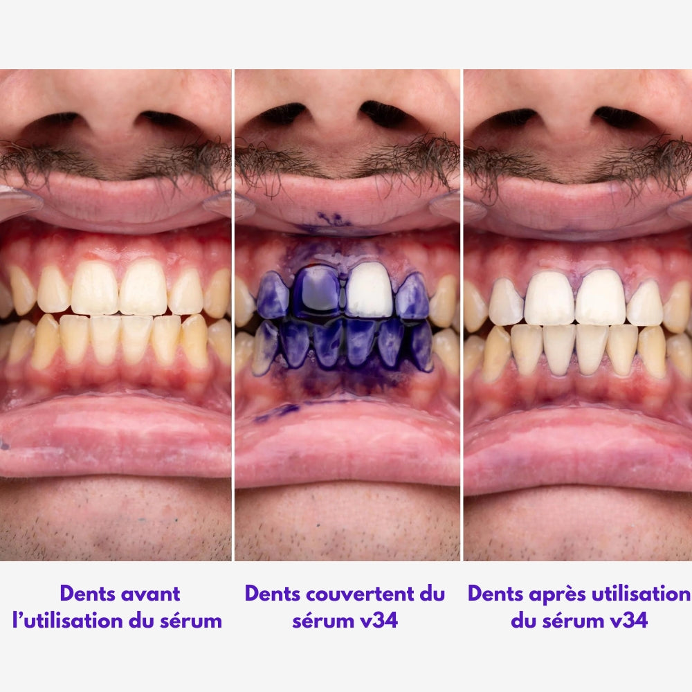 Sérum Correcteur de Couleur Dentaire